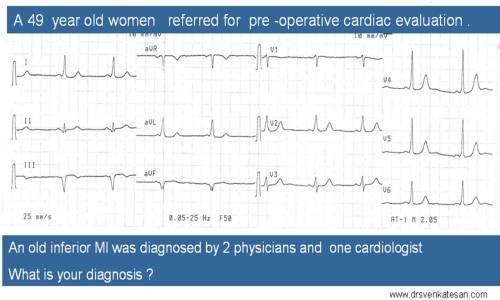 Beware of non infarct q waves : A women with an unusual pathological q waves