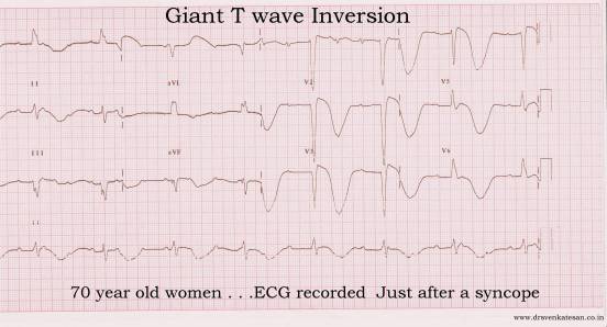 Ischemia On Ecg. A typical ECG from our CCU