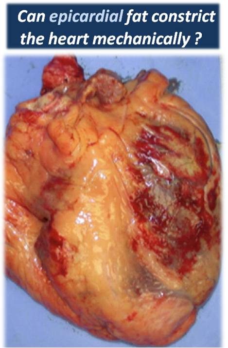 http://drsvenkatesan.files.wordpress.com/2011/07/epicardial-fat-and-constrictive-physiology-pericarditis-epicarditis-lipocarditis.jpg