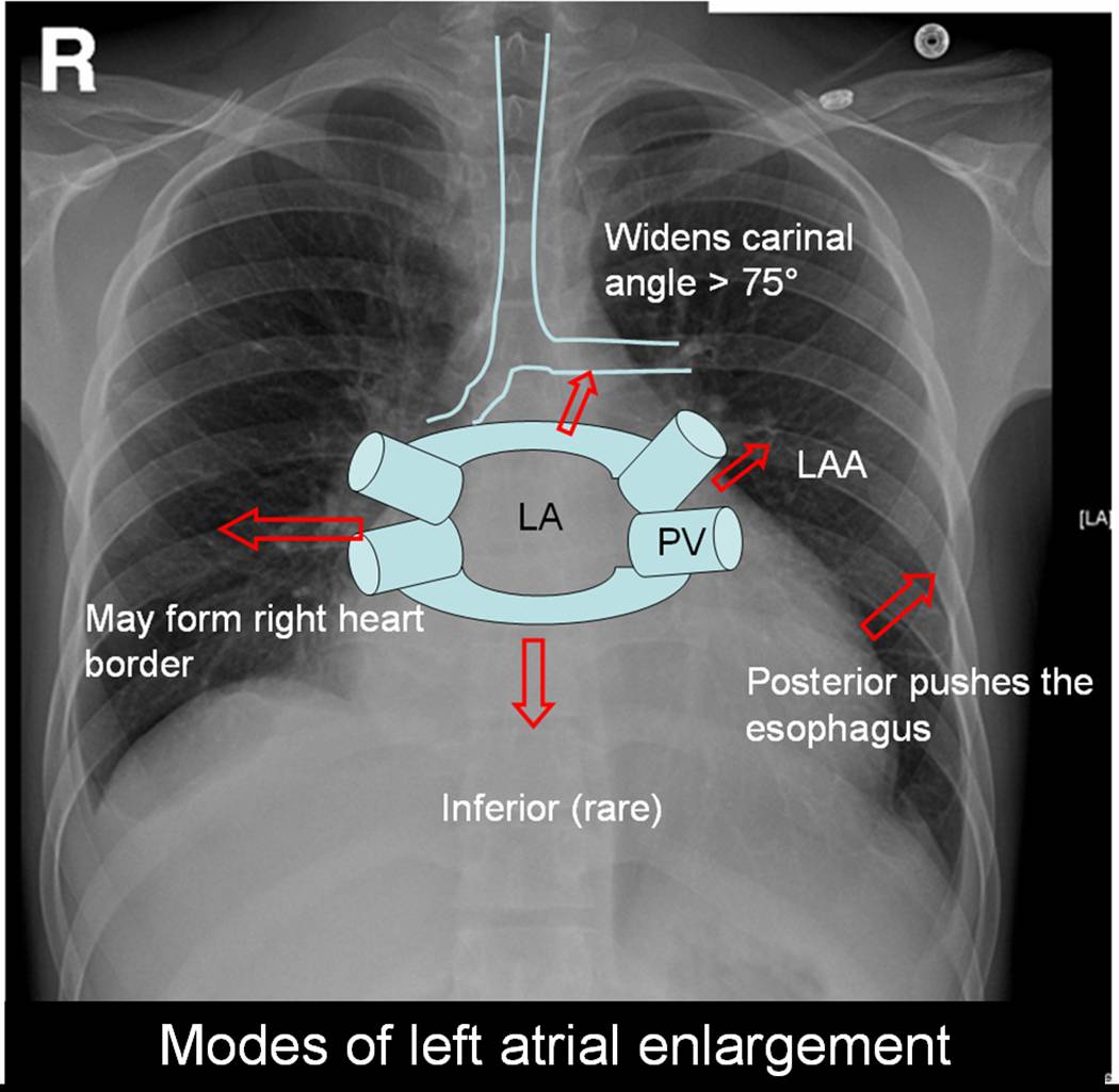 What are the causes of mild left atrial enlargement?