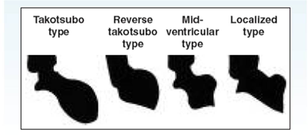 What are some symptoms of takotsubo cardiomyopathy?