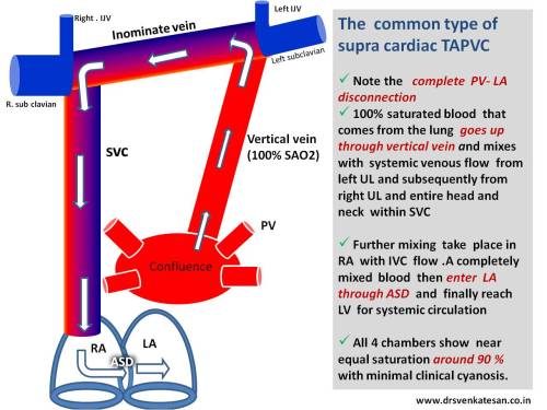 TAPVC Total anomalous pulmonary venous connection left vertical vein