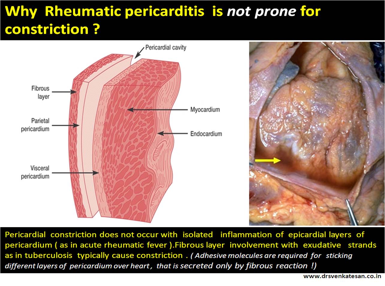 why rheumatic pericarditis does not go for constriction