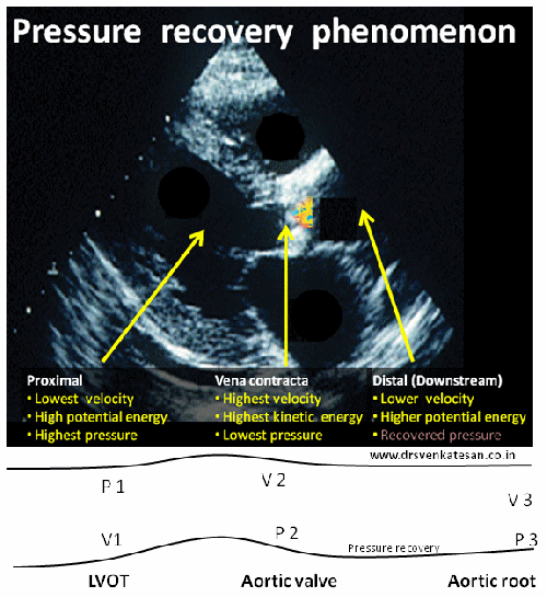 pressure recovery phenomenon in aortic stenosis 005