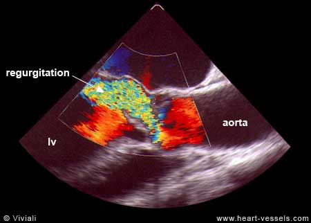 aortic-insufficiency