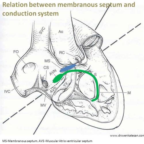 membranous ventricular septum 2